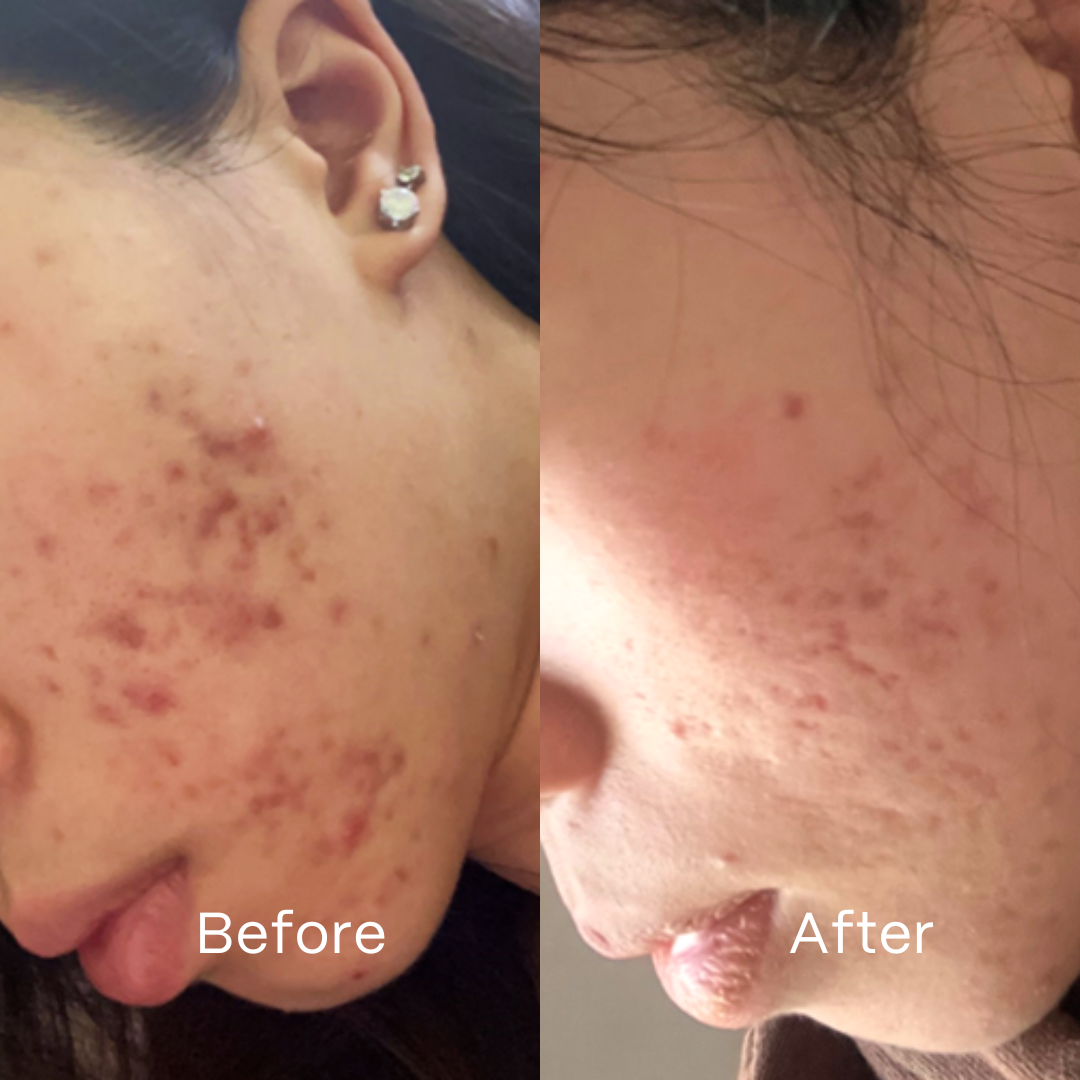 What Really Causes Acne? Hormones, Microbes and Inflammation