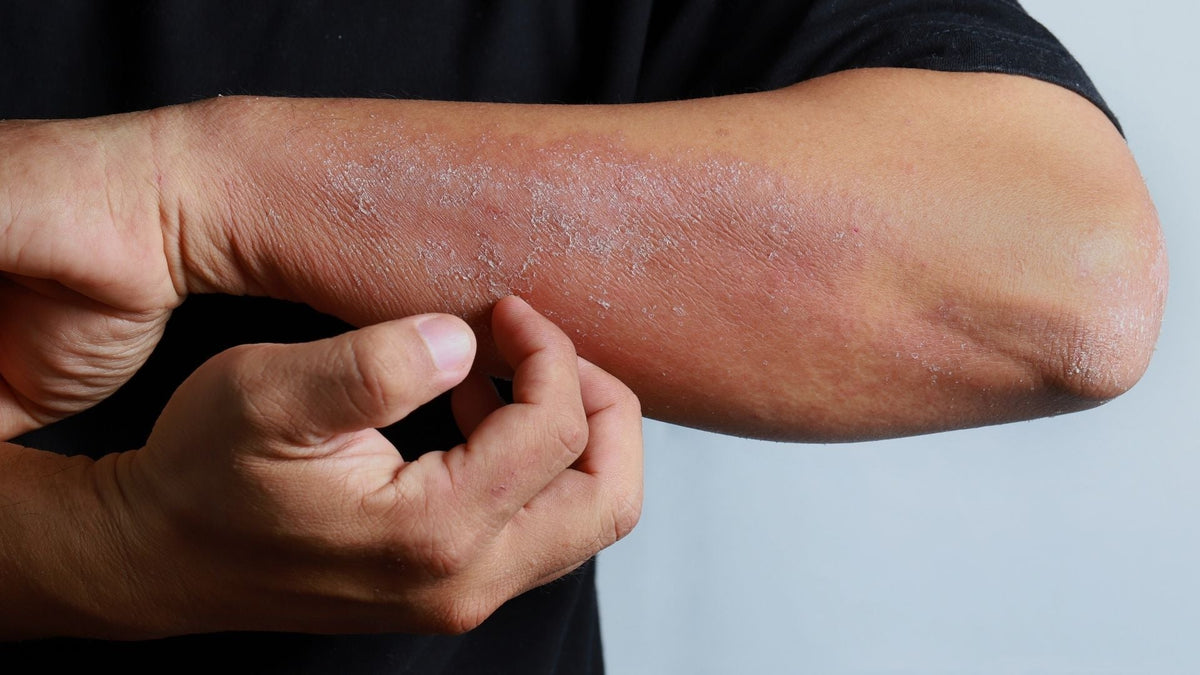 Autoimmune Driven Skin Irritation and the Skin Microbiome: Why Dry Skin Becomes Inflamed