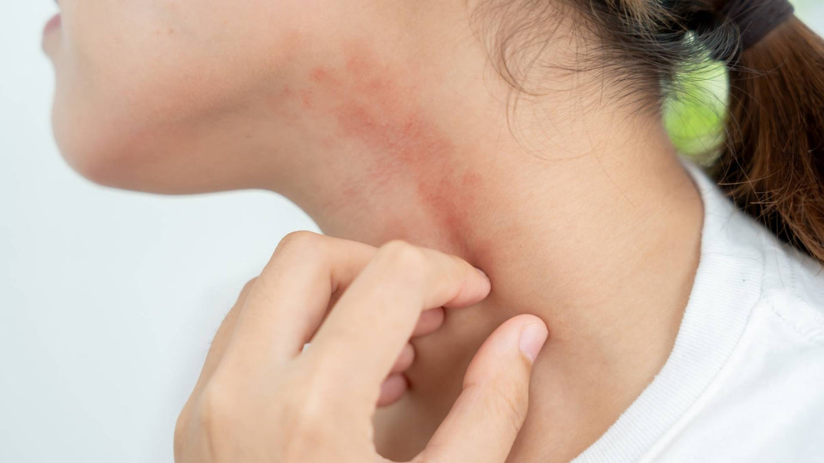 Why Pimples, Spots and Blemishes Leave Dark Marks: Post-Inflammatory Hyperpigmentation